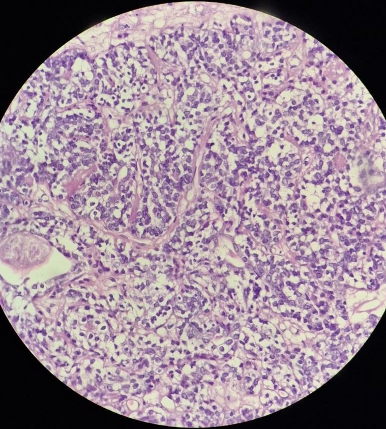 getnet_ghi95154's tweet photo. 40F Thigh dermal based nodule, thoughts? https://t.co/8VGVHTn3D6