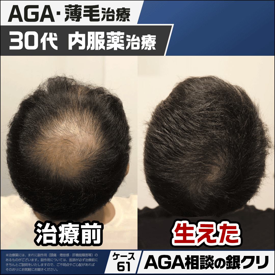 gincli_aga's tweet photo. 【銀クリのAGA相談室 89】
Q. AGA治療って、ずっと同じ薬を飲み続けるものなの？

近頃では治療薬を定期配送する
サブスク型のAGA治療も増えています。
私たちのクリニックでも
オンライン診療にて治療薬を
ご自宅に配送するケースがありますが、
銀クリのAGA治療は医療本来のあるべき姿を
重視し仮にオンライン診療であっても
毎月医師が症状を確認の上、
都度適切な治療薬を種類・服薬量を鑑み
処方しています。

それはより効果的な治療を
行うことはもちろん、副作用や効果の
頭打ちに対する対策でもあります。
患者様の症状や経過に合わせて
最適化（微調整）した処方が
AGA治療において最も重要な
ポイントの1つと考えております。

---

こちらの症例は30代から治療開始した
患者様です。
都度改善に合わせ治療を重ね、
8年が経過した現在も良好な状態を
維持しています。

■ 発毛に至るまでの治療
30代で来院。頭頂部を中心に広い範囲で
薄毛が認められました。
内服薬と育毛メソセラピーを
組み合わせることで
5ヶ月目には全体に症状が改善しました。

■ 症状が改善してからの治療
ある程度薄毛が改善してからも
より発毛を期待し治療を継続しています。
・フィナステリド ⇒ デュタステリドへ変更
・ミノキシジル濃度を経過に合わせて増減
・育毛メソセラピーの継続

その後、デュタステリドやミノキシジルを
経過に合わせ調整したり休薬をしたりなど
適切な対応を行うことで、
治療薬の耐性もなく8年が経過した現在も
非常に良好な状態です。

30代からのAGA治療で、
10年先もフサフサな髪を維持するために
「最も重要なこと」とは？
詳細はリプライへ続きます👇