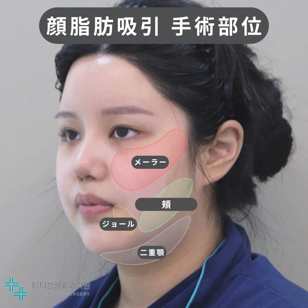 TTps_jp's tweet photo. 🩵TT顔脂肪吸引の部位表記を一部変更しました🩵
分かりやすくするため
旧『フェイスライン』→新『頬』に変更✨
メーラー・頬・ジョール・二重顎
お悩みに合わせて部位別にご案内します🙇‍♀️💎

TT整形外科♡MENUはこちら｜韓国TT美容整形外科♡ティーティー♡ https://t.co/03k7nbIFPP 
＃顔脂肪吸引 https://t.co/UsXfqFPf3a