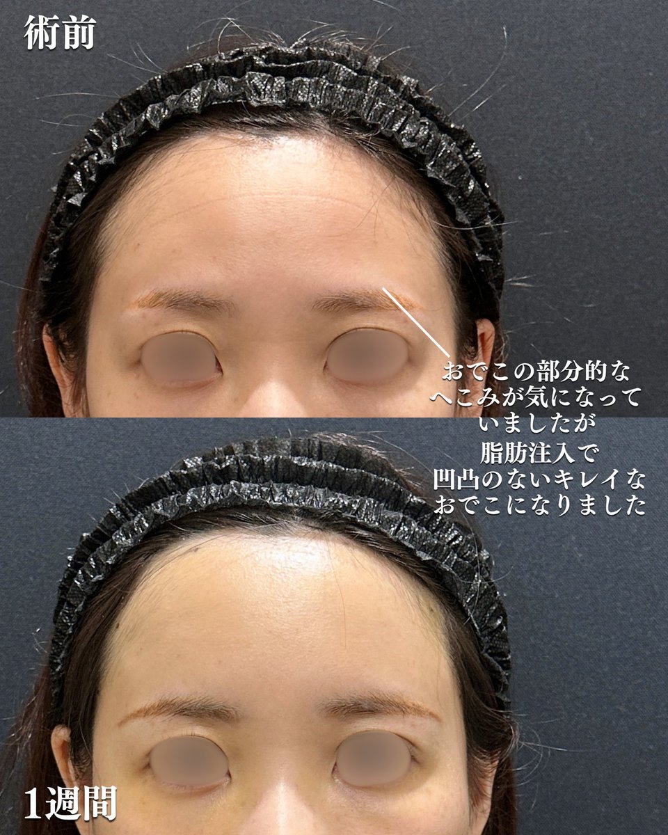 dr_h_watanabe's tweet photo. おでこのゴツゴツ感、眉上との段差、年齢と共に気になってきますよね？
自分の脂肪をおでこに移植すると段差のない綺麗なおでこにできますよ😊

ご予約は↓からお願いします
Tel.0120-489-100
or
https://t.co/VCZHt5Pnzs https://t.co/riQ2jWBuyq