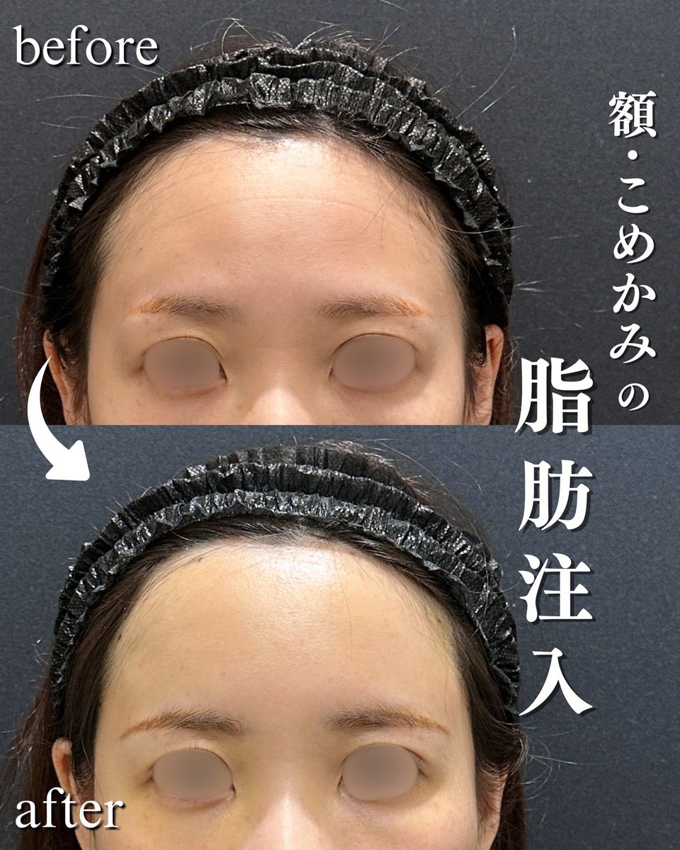 dr_h_watanabe's tweet photo. おでこのゴツゴツ感、眉上との段差、年齢と共に気になってきますよね？
自分の脂肪をおでこに移植すると段差のない綺麗なおでこにできますよ😊

ご予約は↓からお願いします
Tel.0120-489-100
or
https://t.co/VCZHt5Pnzs https://t.co/riQ2jWBuyq