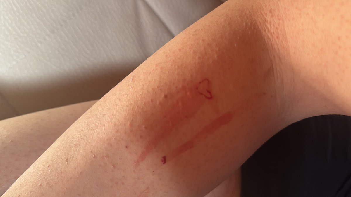 cloecatboy's tweet photo. Wtf random heart shaped bleed happened. I didn’t even do anything like literally 😭 https://t.co/Na4nNUCSdy