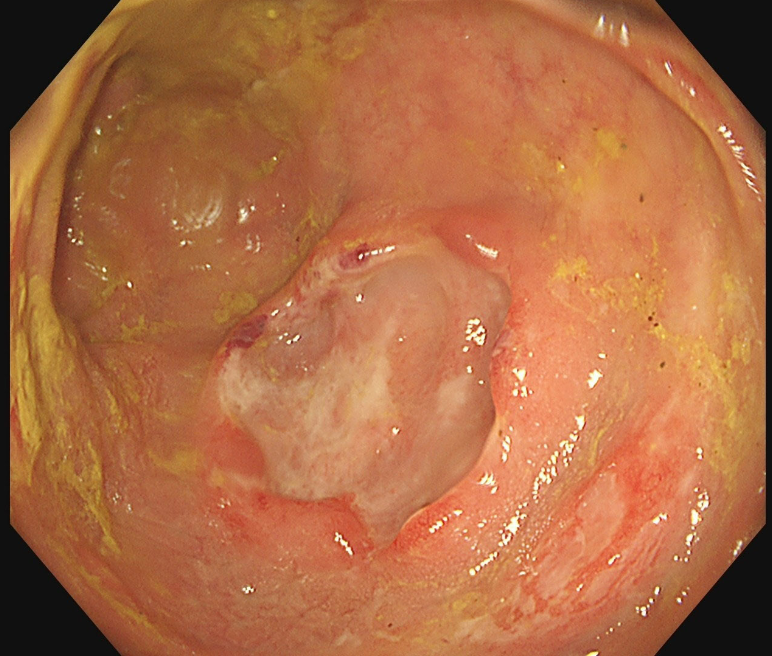FrontGastro_BMJ's tweet photo. Diarrhoea and abdominal pain — routine presentation, or something more? 🧩🩺

This “Inside view” case in @FrontGastro_BMJ takes readers through a patient presenting with diarrhoea and abdominal pain, using clinical clues to sharpen diagnostic reasoning and avoid premature closure. 🔎📋

A great teaching read for gastroenterologists, trainees and anyone who enjoys a diagnostic challenge.

Read more: https://t.co/yaRI3av6XY

#Diarrhoea #AbdominalPain #DiagnosticChallenge #Gastroenterology #CaseReport #FrontlineGastro #GItwitter #ClinicalMedicine #MedEd @BritSocGastro @my_UEG @AmCollegeGastro @DDWMeeting @ESGE_news @PhilSmithIsBack @OTavabie @dr_aditi_kumar @TrevorTabone @eathar_s @IrenePerezMD @KGananandan @zare_benjamin @medicalreg @dtleiberman