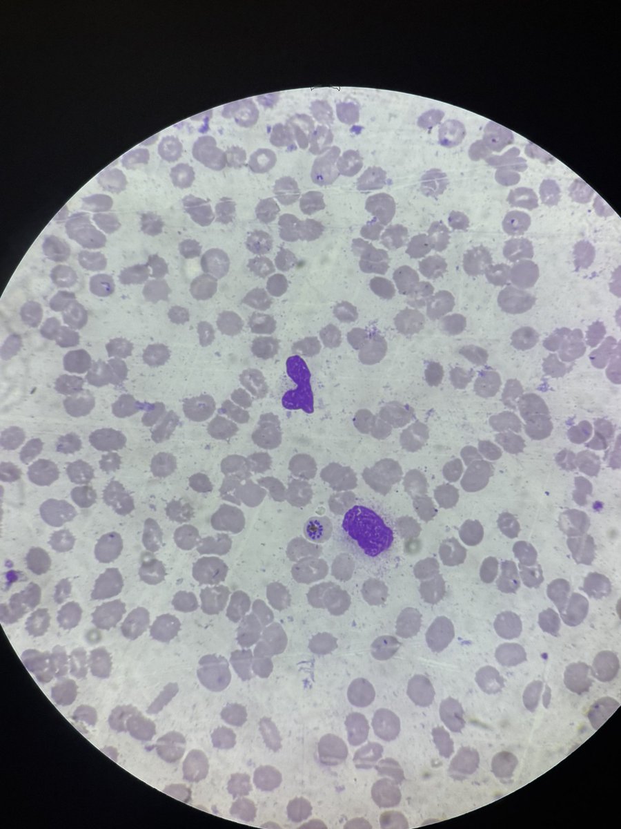 Drmona1995's tweet photo. 30 yr male, fever, thrombocytopenia, mild splenomegaly. Slide is speaking for itself. Dx???
#patho #medx #pathx #medicine #hematology https://t.co/zKeOtD7JuB