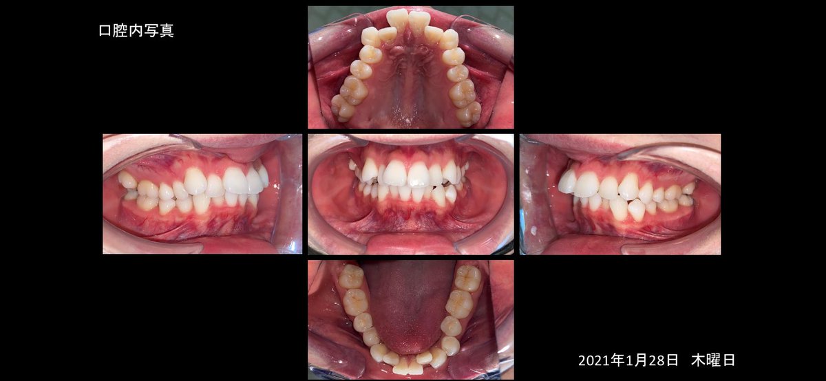 pic_teeth's tweet photo. 口腔内写真7回目
5枚、9枚

#口腔内写真 https://t.co/kw0GlB2h0L