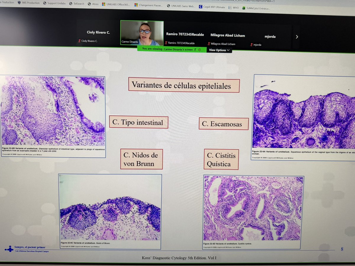 CiolyRiveroC's tweet photo. No todo puede ser malo 😇 vs 😈 Que nos cuentan las orinas cuando no hay tumor? @CDinares @SECitologia fantástica presentación 👏🏼 @citologiala #GUpath #cytology #cytopath #cytolovers #SLAC #SEC https://t.co/QOmliUHQer