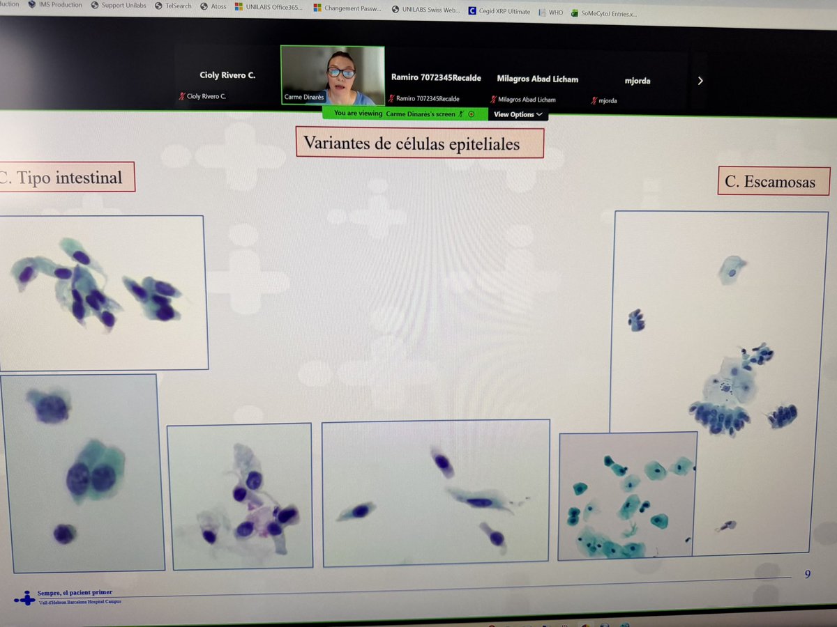 CiolyRiveroC's tweet photo. No todo puede ser malo 😇 vs 😈 Que nos cuentan las orinas cuando no hay tumor? @CDinares @SECitologia fantástica presentación 👏🏼 @citologiala #GUpath #cytology #cytopath #cytolovers #SLAC #SEC https://t.co/QOmliUHQer