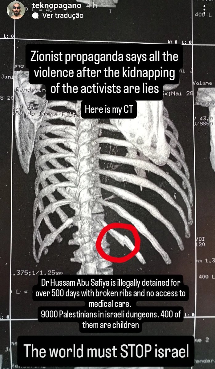 tiagoguilhermef's tweet photo. Meu conterrâneo e compatriota, o médico brasileiro Cássio Pellegrini, está compartilhando o raio-x que comprova a fratura de uma de suas costelas após agressões sofridas sob custódia de soldados israelenses.

Chega a ser absurdo que as vítimas tenham de expor exames médicos e documentos pessoais para convencer parte da opinião pública de que a violência ocorreu. Essas provas estavam sendo preservadas para as ações judiciais e procedimentos que vêm sendo preparados contra o Estado de Israel pelas violações cometidas. Ainda assim, diante das tentativas de negar ou minimizar os fatos, muitos sobreviventes estão se vendo obrigados a divulgar evidências que jamais deveriam precisar tornar públicas.

Estamos falando de um médico brasileiro que retornou com uma costela quebrada após ser agredido. Não se trata de boatos, especulações ou relatos anônimos. Trata-se de lesões documentadas, constatadas por exames médicos.

O fato de vítimas precisarem publicar seus próprios raios-x para que suas denúncias sejam levadas a sério já diz muito sobre o nível de desumanização e descrédito que enfrentam. Mas os fatos continuam aparecendo. E as evidências continuam se acumulando.