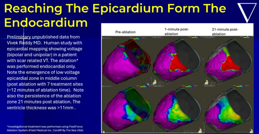 EPLive2's tweet photo. Big session on the screen at #EPLive2026: Dr. Andrea Natale is presenting a recorded case on Ventricular Tachycardia (VT) ablation using Pulsed Field Ablation (PFA) by Field Medical! ⚡️🫀

Taking PFA technology beyond AFib and into the ventricle for safer, more tissue-selective VT management.

#EPLiveAustin #EPLive #PulsedFieldAblation #Cardiology #EP
