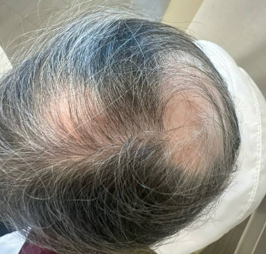 SunjayMD's tweet photo. An elderly woman with history of #bronchiectasis and recurrent exacerbations was started on a new therapy, which has been helping significantly. 

Within 6 months, however, she complained of new onset, significant hair loss (see below). What do you think caused this and what should we do next?

@ProfJDChalmers @AlibertiStefano @PCDFoundation @williamkellymd