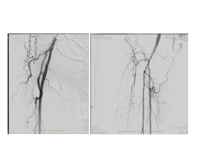 CathLabDigest's tweet photo. Usman and Zakir highlight how the DETOUR™ System from Endologix may expand revascularization options in complex femoropopliteal disease, including long lesions, prior stents, and heavily calcified anatomy.

https://t.co/UmYnDglvuD https://t.co/VlNekZaXJo