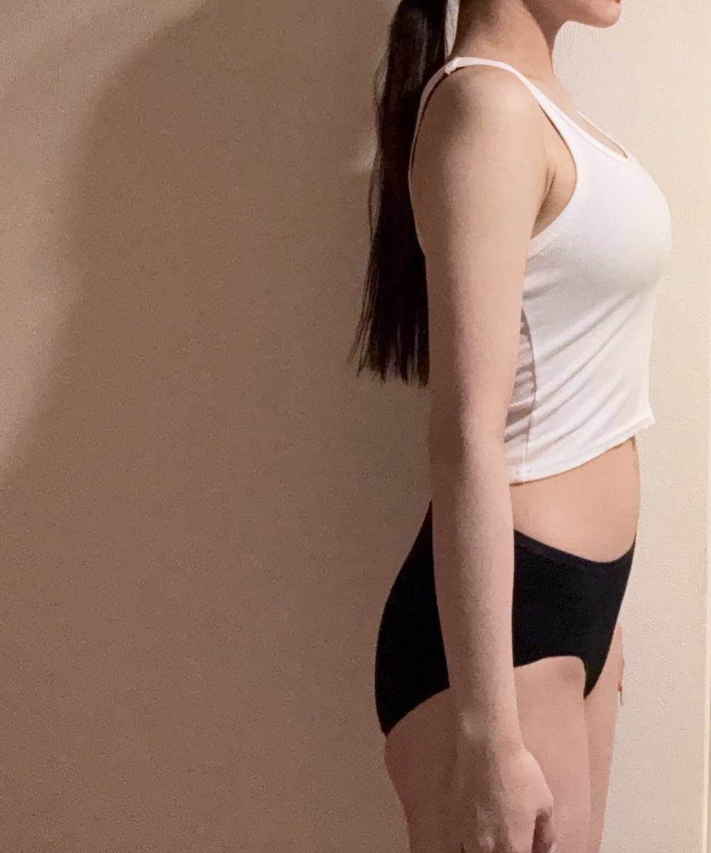 pikuminjp2002's tweet photo. @Lesarts_JP で二の腕脂肪吸引と胸の脂肪移植をして1ヶ月が経過ました。拘縮やアザなく綺麗な状態なので、あとは傷クリームを塗るのを頑張ります！胸は腫れがひいて柔らかくなりました。サイズダウンしないように頑張ります。 #レアート  #ソ院長 https://t.co/SUPxASjlPn