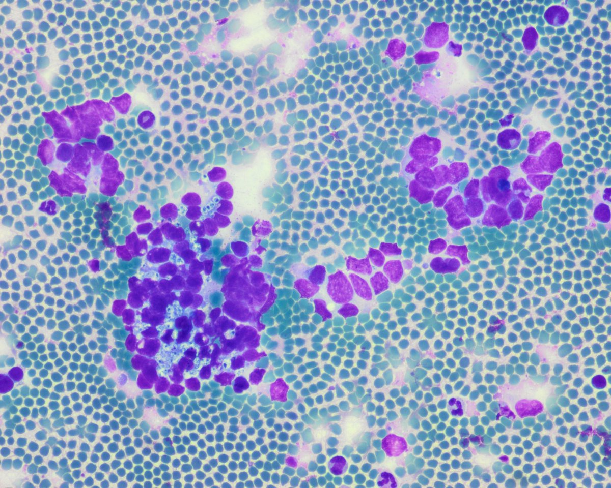 pepeheffernan's tweet photo. CC389. Organ and diagnosis. #cytopath @kriyer68 @premcharles @DrRanasaleh @smlungpathguy @Histiocita @RibianszkyA @padmapathology1 @DrGeeONE https://t.co/eiFxaixjhV
