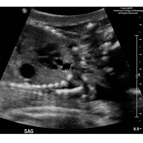 RadiologyACR's tweet photo. A 27-year-old female G2P1 (gravida 2, parity 1) at 20 weeks gestational age presents with an abnormal finding on routine anatomy scan. #ACRCaseinPoint https://t.co/87cuEAGSwd https://t.co/klBQqHkc1i