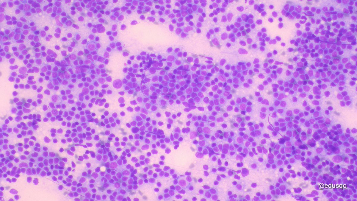edusqo's tweet photo. When dealing with a lymph node I find very useful to properly manage the sample during ROSE to get:
▫️Good smears (be gentle)
▫️Clot for #CellBlock
▫️Dilution in physiological saline for Cytospin
▫️Needle rinse for flow cytometry
Follicular lymphoma
#CytoPath #FNAFriday #HemePath https://t.co/ywTpl8xWVK