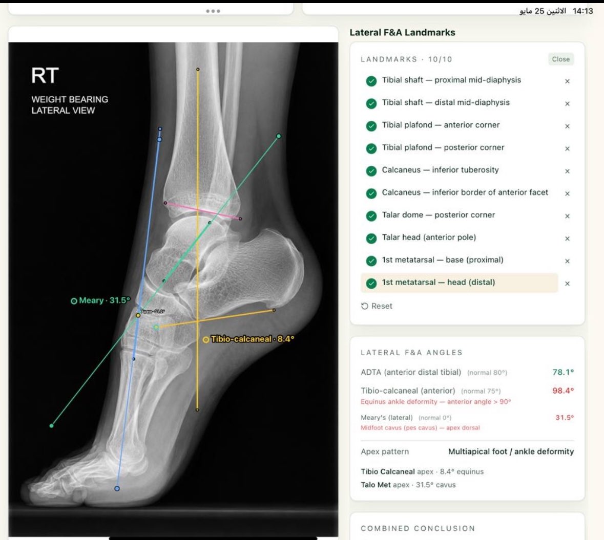 Orthophilic's tweet photo. الى زملائي الكرام في جراحة العظام والأشعة التشخيصية،
يسعدني أن أشارككم تطبيقًا متخصصًا في تحليل #تشوهات_الأطراف والتخطيط الجراحي #BoneAxis ، طُوِّر بعناية ليكون أداة عملية ودقيقة تُعين الطبيب على دراسة التشوهات العظمية بمنهجية واضحة وأسلوب ميسّر.
وبفضل الله وتوفيقه، تولّيت كتابة وتصميم خوارزميات تحليل الأطراف السفلية بالكامل ، شاملةً قياس الزوايا والمحاور لكل مفصل في الجهتين اليمنى واليسرى؛ ليعمل التطبيق كمنصة ذكية متكاملة تدعم اتخاذ القرار الجراحي بثقة.
ويتميّز التطبيق بأنه يأخذ المستخدم خطوة بخطوة في رحلة التحليل والتخطيط، فيُحوِّل العمليات المعقدة إلى مسار واضح ومنطقي، ويُسهم في تحديد موضع القص العظمي (Osteotomy#) الأنسب، واختيار أسلوب التصحيح الأمثل لكل حالة على حدة ويزودك بتقرير كامل عن كل تشوه على حدة ونوع التشوه اذا كان ناتج عن العظم او من الانسجة ماحول المفصل، كما يدعم مشاركة التحليل عن طريق البريد الالكتروني او الواتسب او الـAirdrop.
كما يضمّ التطبيق مكتبة من الإطارات الخارجية والمحاكاة الجراحية، التي تمنحك تصوّرًا دقيقًا للنتيجة المتوقعة قبل التدخل الجراحي، مما يرفع من دقة التخطيط ويُحسّن مخرجات العمل الجراحي بإذن الله.
أسأل الله أن ينفع به، وأن يكون عونًا لكم في خدمة مرضاكم

https://t.co/6zLxt4y0Zy

#Deformity
#Osteotomy_Hub