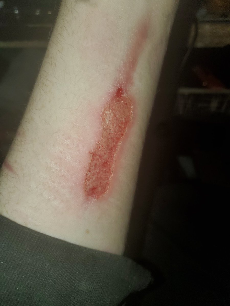 59_SINNER's tweet photo. Been into burning lately #shtwt #selfharm #sh https://t.co/OlTLfbBzqG