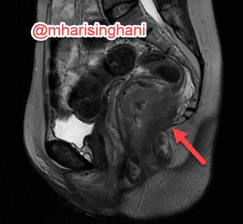 mharisinghani's tweet photo. This MRI can pass off as that for rectal cancer; but this was squamous cell anal cancer; remember we only apply rectal MRI template when we see pathologic report showing adenocarcinoma; for squamous cell template is different and so is therapy https://t.co/ri4K1q0sxH