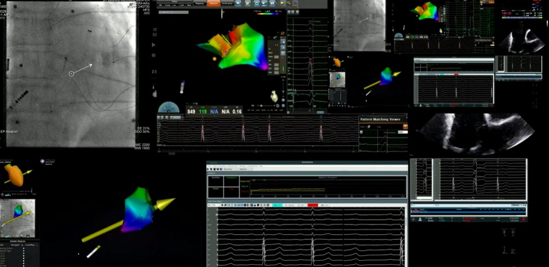 EPLive2's tweet photo. Moving to the next highly anticipated case at #EPLive2026: Dr. Khaled Awad is discussing VT ablation utilizing the Affera platform! 🫀⚡️

Reviewing a 73yo man with recurrent outflow tract (OT) PVCs post-March 2026 ablation, a 20% burden, and an LVEF drop down to 45%.

#EPLiveAustin #EPLive #Cardiology #EP