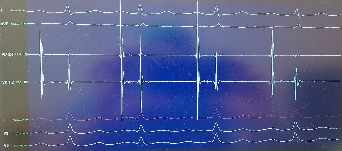 EaRajjoub's tweet photo. PR alternans with narrow QRS does not always reflect a shift in conduction between the fast and slow pathways

#Epeeps https://t.co/gqMPbjSYjV
