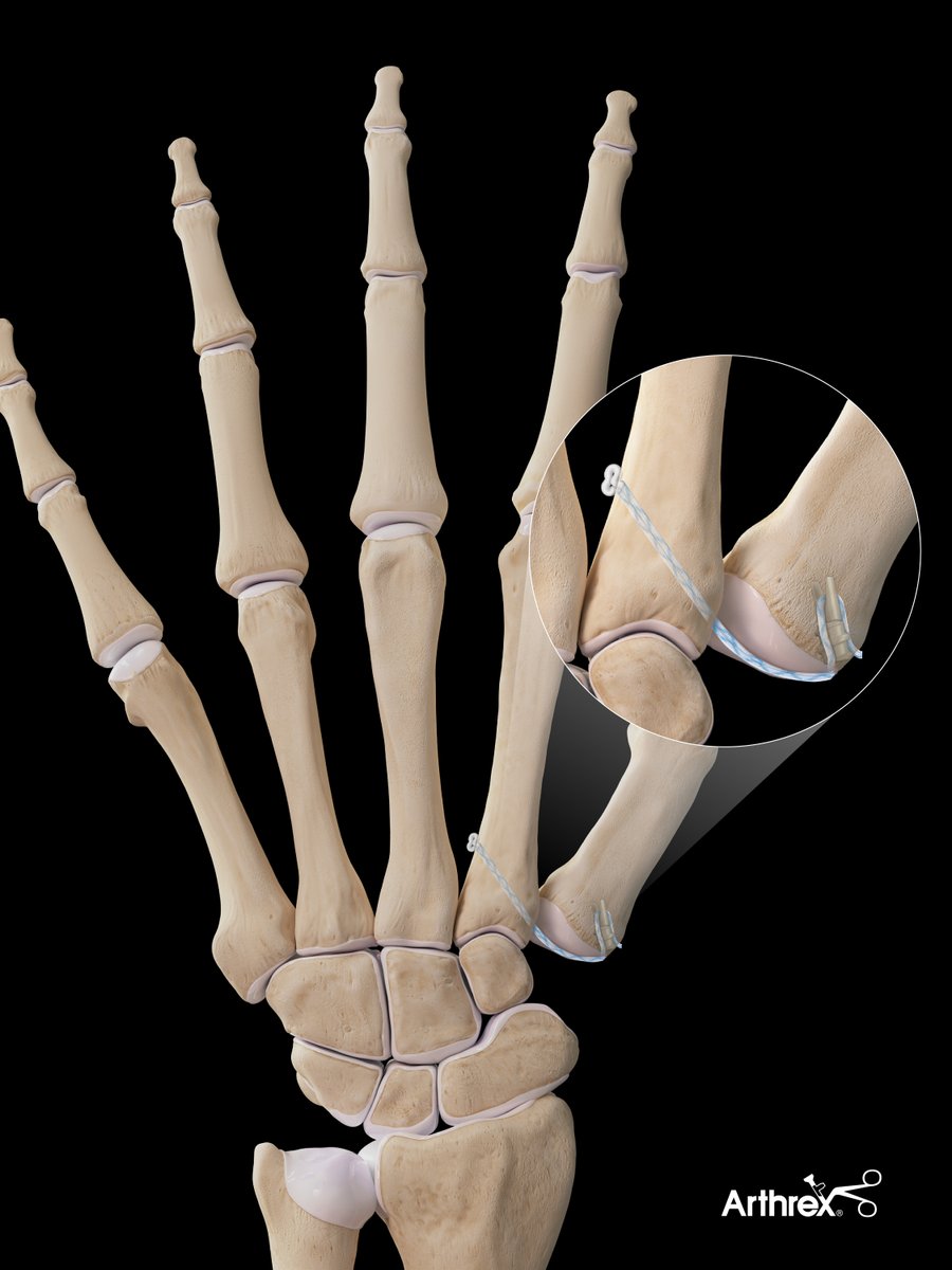ArthrexMedEd's tweet photo. The FiberLock™ suspension system is a single-incision suture suspensionplasty using the latest in anchor and suture technology. A FiberTak® all-suture anchor provides cortical fixation on the far cortex of the 2nd metacarpal. SutureTape from the FiberTak anchor is then brought beneath the thumb metacarpal and secured into the base of the 1st metacarpal using a 3.5 mm DX SwiveLock® suture anchor.

Learn more: https://t.co/PiMimBteiY