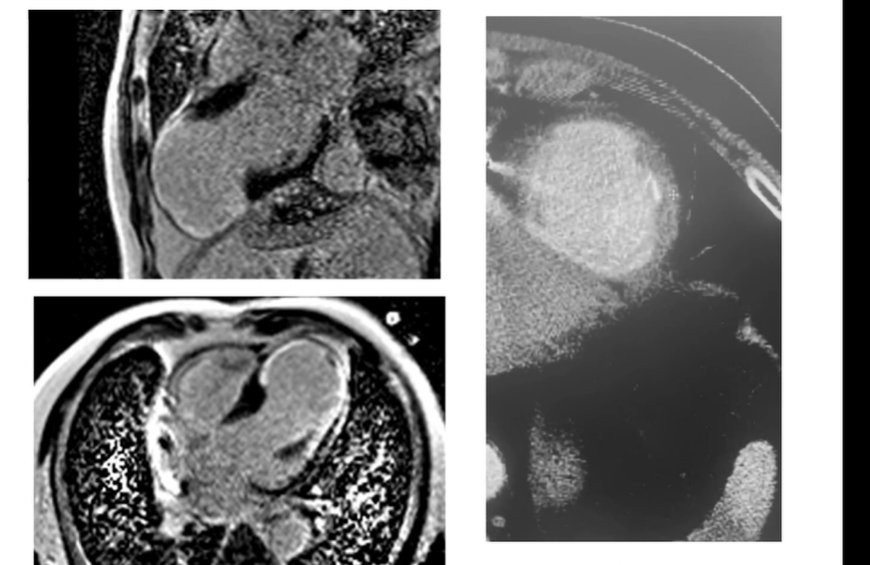 EPLive2's tweet photo. Back on screen at #EPLive2026: Dr. Khaled Awad presents another compelling VT ablation case using the Affera mapping & ablation system. 🗺️⚡️

Discussing a complex 71yo man with ICM, a chronically occluded LAD, LVEF of 25%, and recurrent VT at 150 bpm.

#EPLiveAustin #EPLive #Cardiology #EP