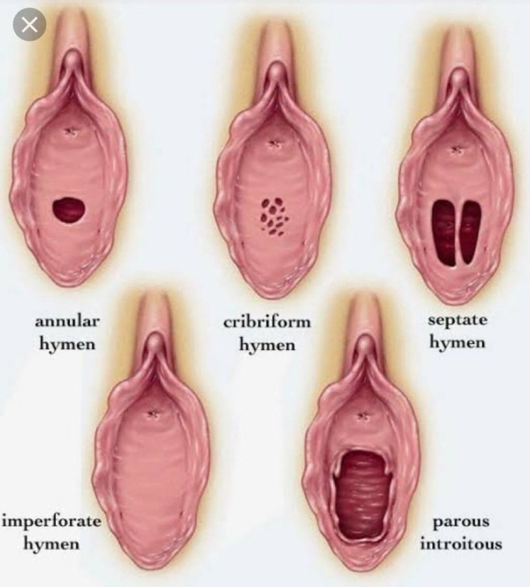 Doctors__squad's tweet photo. Let's talk seriously about an ancient myth that, due to a lack of clear information, continues to cause unnecessary doubts and silent pain.

Many men imagine the hymen as a solid barrier, but anatomical reality is quite different and far more complex.

It's generally an elastic mucosal tissue with natural openings, not a vacuum-sealed guarantee seal.

Everyday activities like gymnastics, using tampons, or riding a bike can stretch or modify it without any prior sexual activity.

That's why it's essential to understand that not bleeding during the first time is something perfectly normal and healthy.

When there's real desire, patience, and good lubrication, the tissue stretches gently to allow passage without breaking.

Bleeding usually happens due to lack of preparation, involuntary muscle tension, or dryness—not from breaking any physical membrane.

Medical science confirms there's no physical test capable of verifying a woman's sexual history with certainty.

Looking for bloodstains as evidence is a serious biological mistake that ignores how the human body actually works.

She didn't lie to you; her anatomy simply reacted with the natural flexibility and health it's meant to have.

Let's break the silence by sharing this information, because trust in your partner is worth far more than an outdated myth. 🧵👇