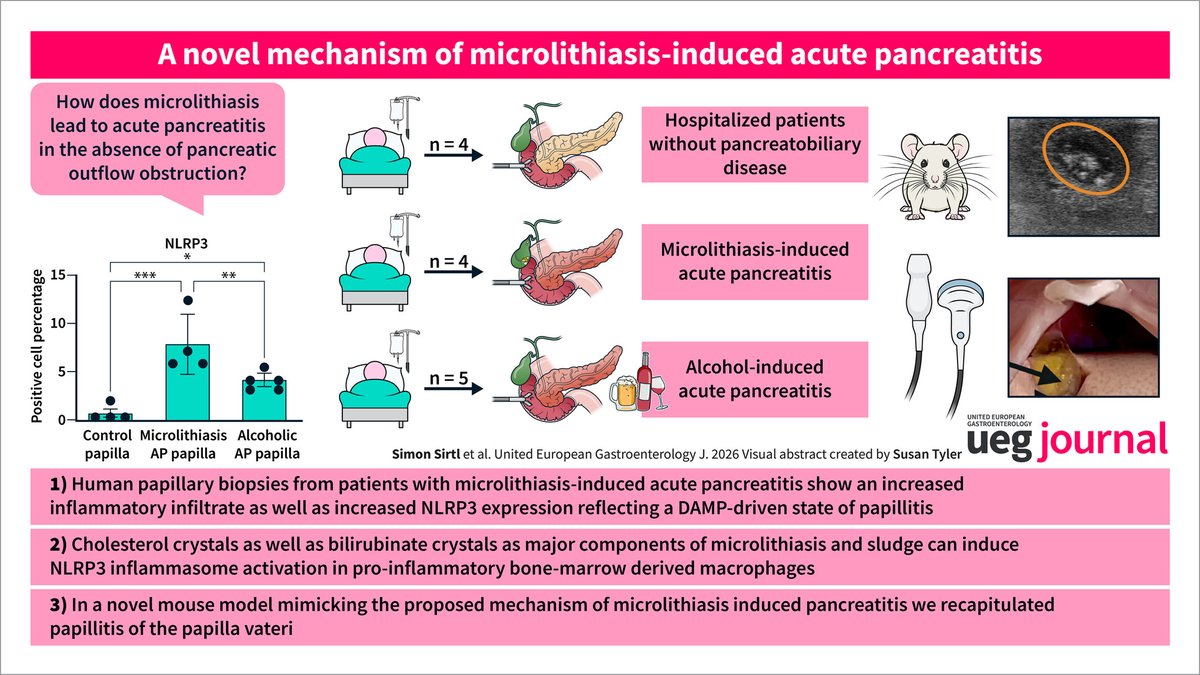 UEGJournal's tweet photo. 🧬 #Microlithiasis may trigger acute #pancreatitis via #NLRP3-driven papillitis
🔸Papillary biopsies showed ↑inflammation & NLRP3
🔸Cholesterol/bilirubinate crystals activated macrophage NLRP3
🔸Supports inflammation as a trigger
📖 #OpenAccess 👉 https://t.co/XpRWgRfV9s https://t.co/f1pbf0WQ4E