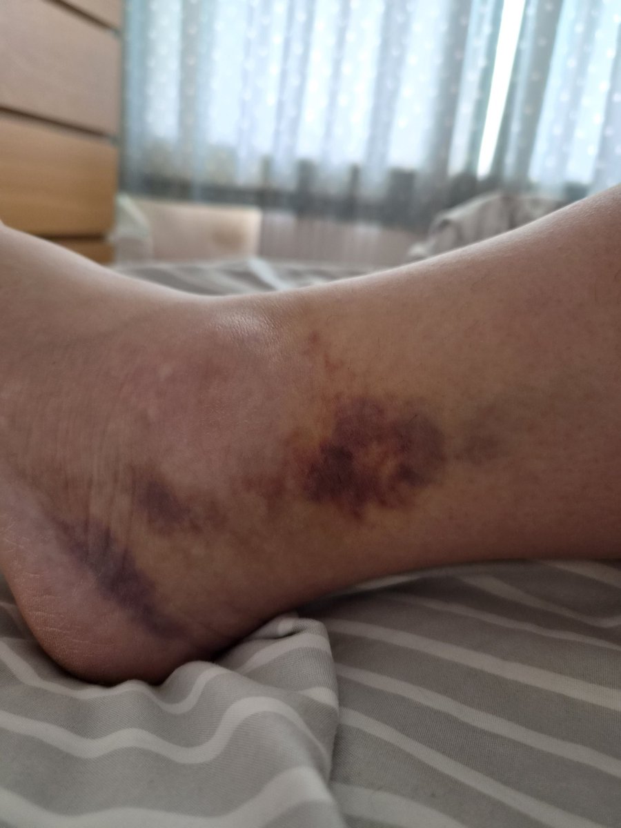 emwithme's tweet photo. It's been one week...

Swelling subsiding.  Bruise is an absolute corker though! https://t.co/bl7gaPk77t