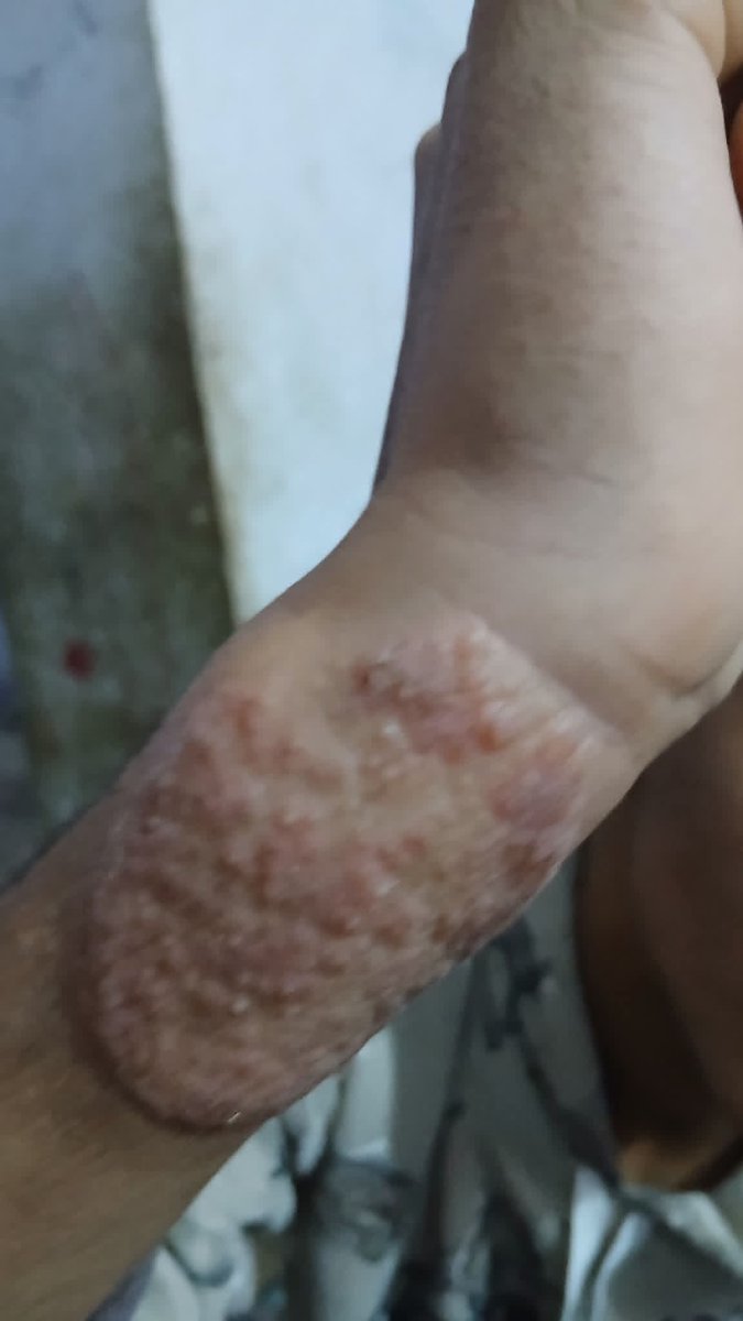 yousefQasem1998's tweet photo. Scabies has spread all over my child's body I am worried about my baby girl 😥😭

 Donate even $10
https://t.co/45Gj0rpJam https://t.co/m8CTFZWoBo