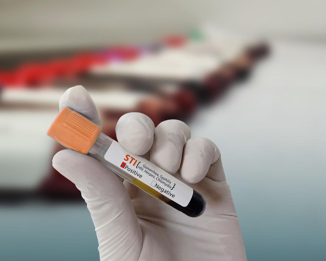 hamlah's tweet photo. #Santé #Europe #IST #Prévention #SantéPublique

Les infections sexuellement transmissibles (IST) atteignent des niveaux records en Europe. Les autorités sanitaires alertent sur la hausse de la gonorrhée, de la syphilis et d’autres infections bactériennes, ainsi que sur l’apparition de souches de plus en plus résistantes aux antibiotiques. Un phénomène préoccupant qui appelle à renforcer la prévention, le dépistage et l’information du public.
 https://t.co/FERNYAmZmp