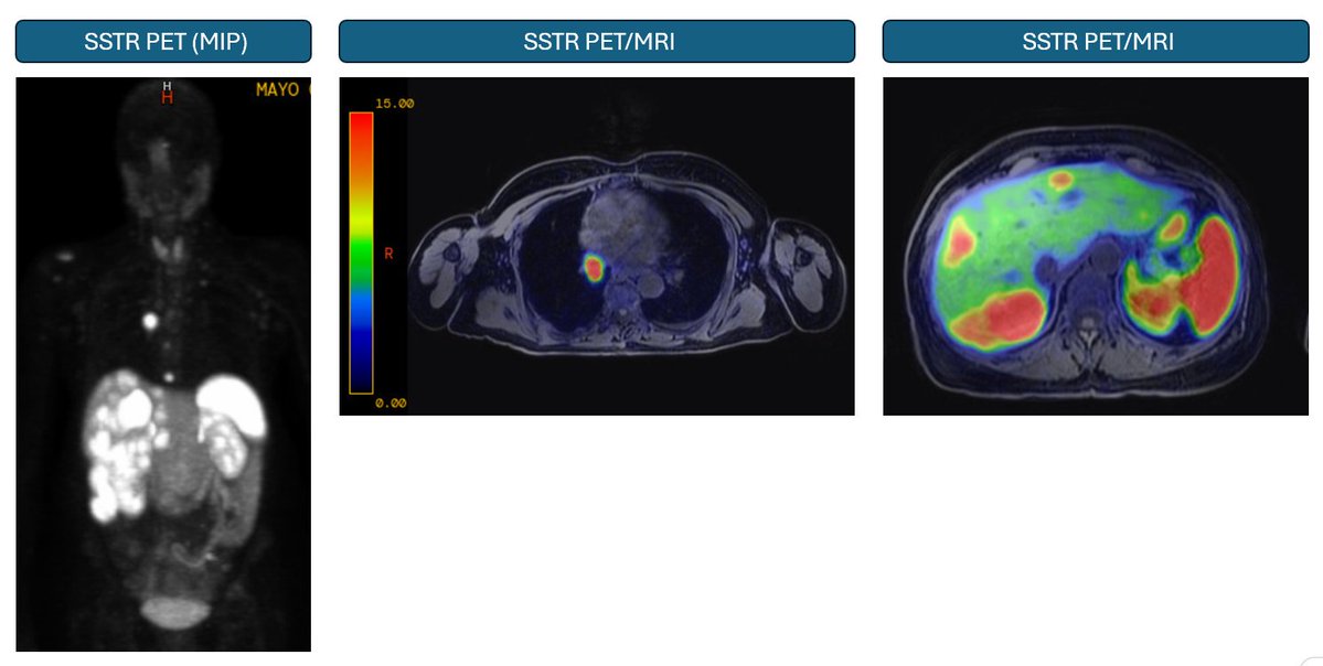 OncoThor's tweet photo. Images from the NET clinic...

Working in the NET clinic is often humbling... Tumors do not read textbooks and sometimes, things just do not make sense but yet are happening right in front of you.  As I often say, every patient with NET is unique (of course, every patient with cancer regardless of cancer type is unique...) with their own clinical presentation.

This patient below has metastatic lung NET, indolent, producing very large amounts of serotonin but with no diarrhea or flushing (serotonin does not cause flushing by the way but does cause diarrhea) so essentially asymptomatic in terms of typical carcinoid syndrome.  This patient however has carcinoid heart disease with severe tricuspid and pulmonary valve regurgitation.  Interestingly, there is no lower extremity edema but there is pulsatile hepatomegaly (a classic finding), both systolic and diastolic murmur, elevated JVP but not a trace of lower extremity edema.

Below you can see evidence of hepatic venous congestion in the venous phase of the CT with what sometimes is called nutmeg  liver.  That lobular pattern is not seen on the arterial phase or on the recent gadoxetate enhanced delayed MRI imaging.

I just thought I should share that carcinoid syndrome can present in very atypical ways without the cardinal symptoms of diarrhea and flushing.  In this case, carcinoid heart disease is the only manifestation of the syndrome.