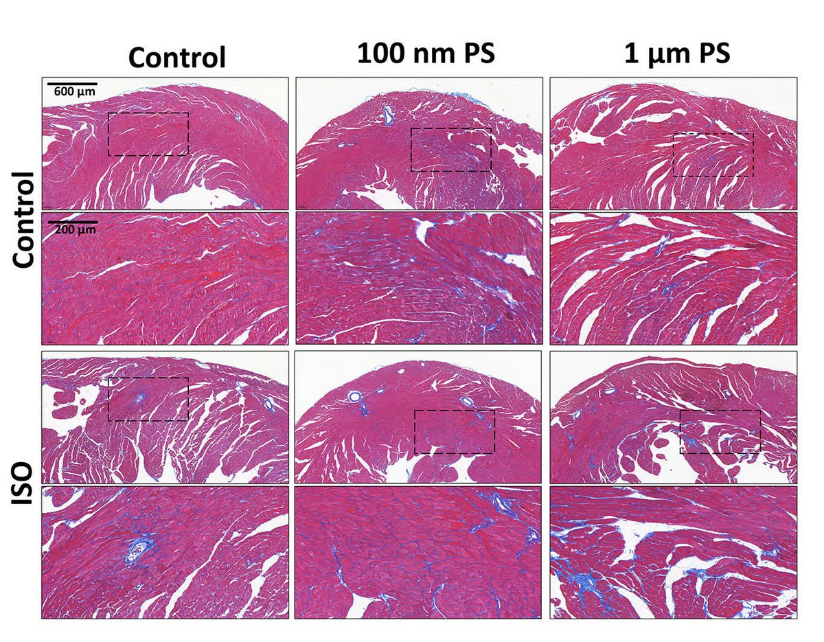 CircRes's tweet photo. Pan &amp; colleagues detected #micro(nano)plastics in human #heart tissue, &amp; higher tissue levels were associated with greater #fibrosis. Learn more about a possible role for plastic particles in adverse cardiac remodeling at https://t.co/cZ0PWeszM4 https://t.co/u5bd6SCJEJ
