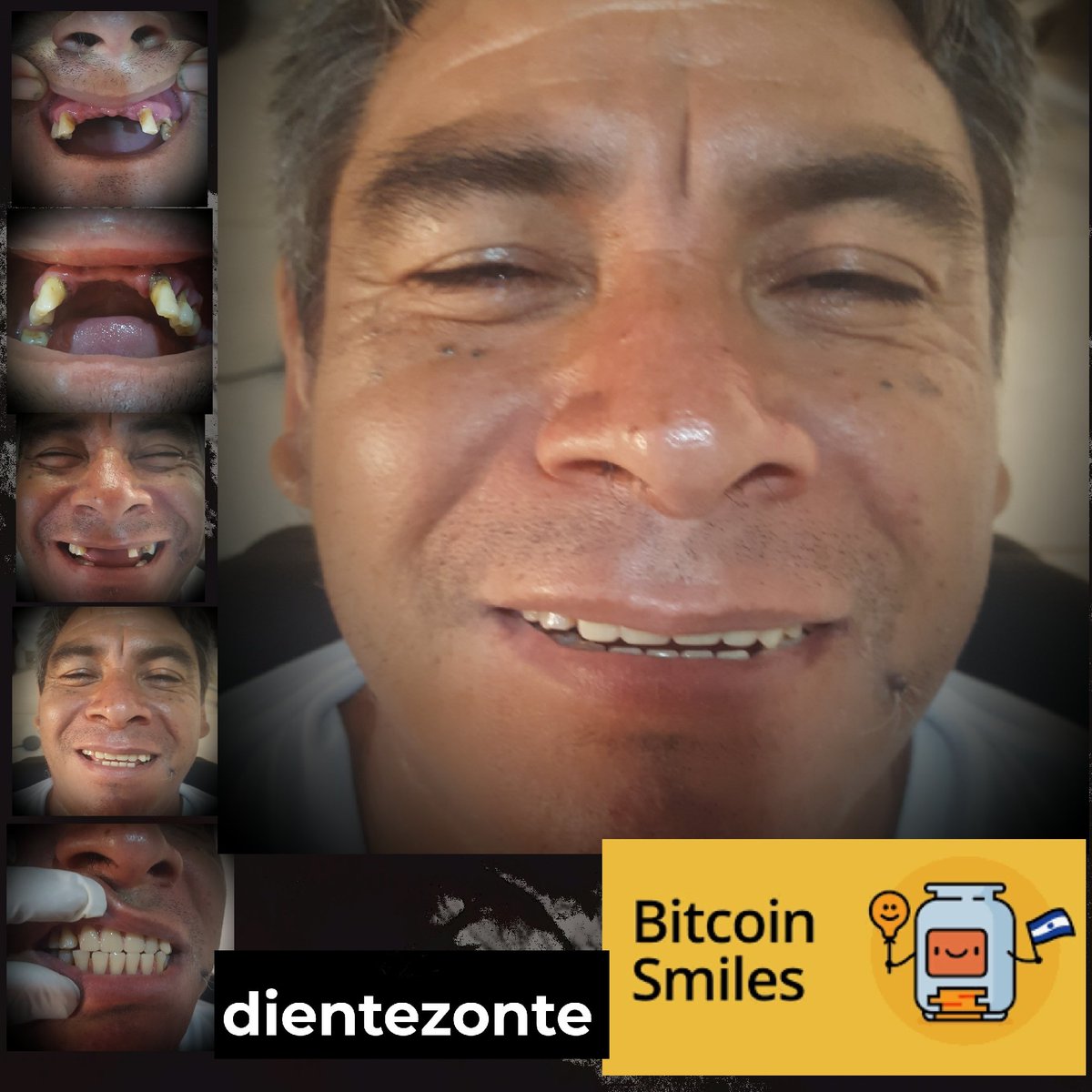 BitcoinSmiles's tweet photo. For over 20 years, Don Raúl has suffered chronic generalized periodontitis that has caused him teeth &amp; boneloss, pain + chronic infection. After multiple extractions &amp; periodontal treatment, we are proud to provide him with a set of dentures and a new smile thanks to BTC 😀🦷 https://t.co/10GI70X4kq
