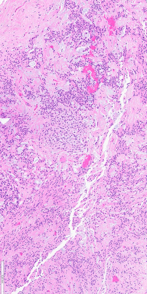 ZemplenPataki's tweet photo. Spine. What is your diagnosis? 🔎

Poll below 🗳️👇

#PathPuzzle 🕵️‍♂️
@UMichPath #Pathology #PathX #PathTwitter
@CraigHorbinski https://t.co/lTfxVOdQKf