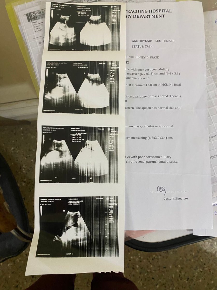 DeborahYeboah16's tweet photo. Hello everyone, please I’m reaching out with a heavy heart to ask for help for a friend’s younger sister, Ms. Reine Amewu (18years), who has been diagnosed with chronic kidney disease and is currently receiving treatment at Korle Bu Teaching Hospital. They have exhausted all the money and resources they have, and at this point, any support no matter how small would go a long way in helping save her life and continue her treatment. Please, if you’re able to help financially or even share this message with others, it would mean so much to the family during this difficult time.
Thank you for your support. 🙏🏽
