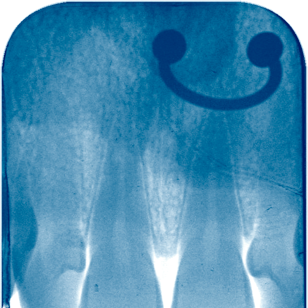 vrson_'s tweet photo. o raio-x do meu dente com o piercing passando uma vibe lorde e underscores tiveram um filhe https://t.co/NCzA6gb5lR
