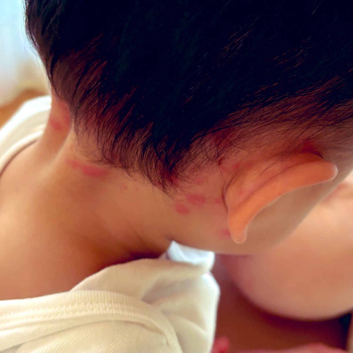y00ty's tweet photo. こんな感じの痒そうなのがお顔や身体に沢山出来ちゃった😭
髪の毛でみえんとこにもたくさん…
あせも？ダニ？
そういうのならまだいいけどなんかしらの感染症の湿疹だとこわい…と思って今日息子の行事あるんだけどとりあえず夫だけ行ってもらった😭ﾄﾎﾎ https://t.co/4dePaVoMUD