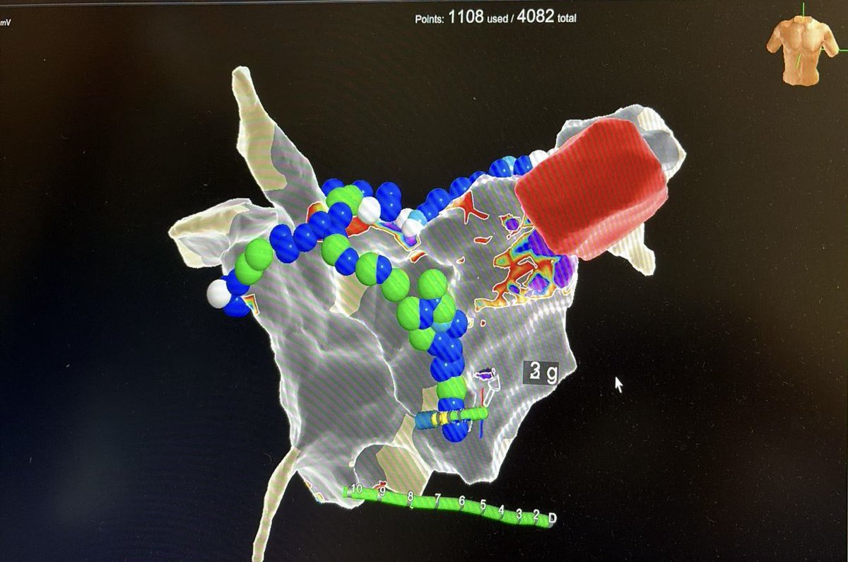 EPWaveDoc's tweet photo. 60F with longstanding AF after rheumatic valve disease. Bioprosthetic MVR. Extensive LA scar, unstable flutters limiting mapping. Empirical point-by-point PFA: first-pass PVI + PWI + anterior line with block. Will SR hold? 🤞 What would have been your strategy, #Epeeps ? https://t.co/NcfuNlaZ5h