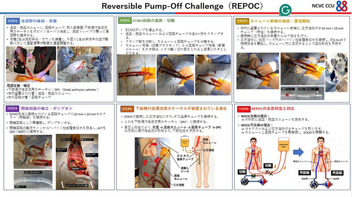 NCVC_CCU's tweet photo. 【REPOC】
冠疾患科専門修練医太田先生、CCU澤田先生監修
Reversible Pump-Off Challenge（REPOC）

VA-ECMO回路とカニューレを維持したまま、一時的に回路を離断し、その状態で血行動態を評価・必要な介入を行う方法です💉

速やかに再装着できる点が大きな利点であり、安全性の高い離脱戦略です🫀 https://t.co/ESI4XhDX0H