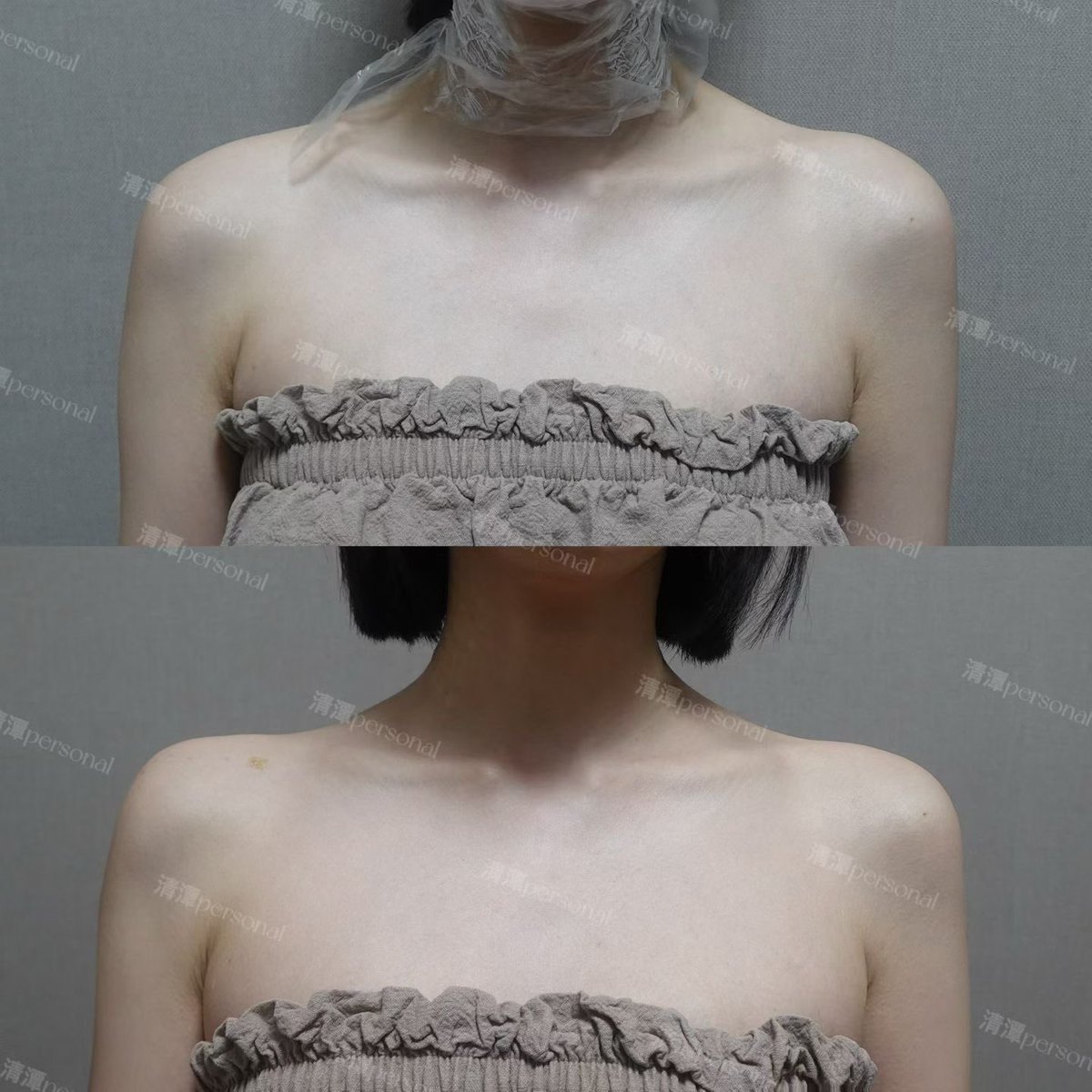 cdpsnjp24's tweet photo. 首から肩にかけてのラインが整うだけで、
フェイスラインまでスッキリ見える印象に！

直角肩フィラーで

🤍 華奢見え
🤍 小顔見え
🤍 ドレス映え
🤍 写真映え

憧れの韓国アイドルのような肩ラインへ✨ https://t.co/GvJn1xE1id