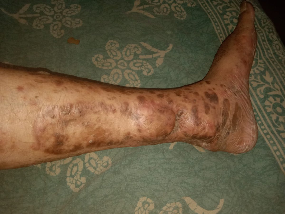 Primrosepink's tweet photo. ⚠️ URGENT MEDICAL HELP NEEDED ⚠️
Rajib Chakraborty &amp; his wife Sukanya frm Madhyamgram, WB, survived a horrific crash in 2025.They r in critical condition, have exhausted all savings, and need immediate,free medical intervention &amp; ambulance transport.@AyushmanNHA
👇 THREAD [1/3] https://t.co/t9ozZ64y2v