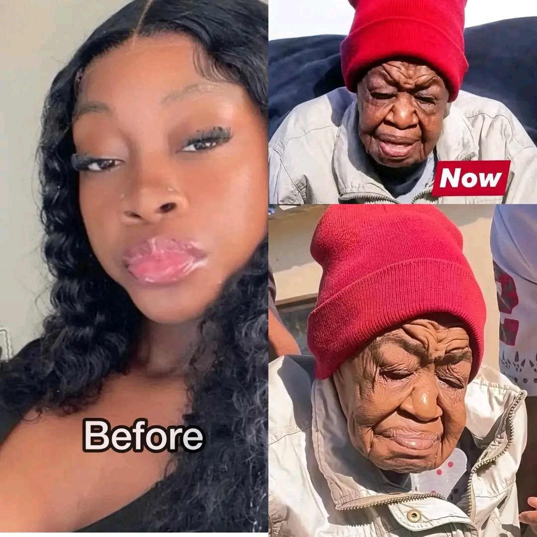 ABB_X02's tweet photo. 31-Year-Old South African Woman Transforms Into an Old Lady After Alleged 53xual Encounter With A Stranger Who Paid Her $20k

A 31-year-old South African woman named Nondie from Mtubatuba in KwaZulu-Natal has captured widespread attention on social media due to her shocking and rapid physical transformation.

Unconfirmed reports circulating online suggest that her dramatic aging began days after she allegedly had a one-night stand with a foreigner, who reportedly left $20,000 on the bed. However, confirmed details reveal she hails from KwaZulu-Natal and lived a normal life until around age 27.

In recent years, Nondie has suffered severe symptoms including intense body pain, frequent vomiting, difficulty walking, and accelerated changes to her skin, hair, and facial features. She now appears decades older, often mistaken for a woman in her 70s, 80s, or even 90s.

Medical experts believe she is suffering from Werner syndrome, also known as adult-onset progeria, a rare genetic disorder caused by mutations in the WRN gene, which impairs DNA repair and leads to premature aging.