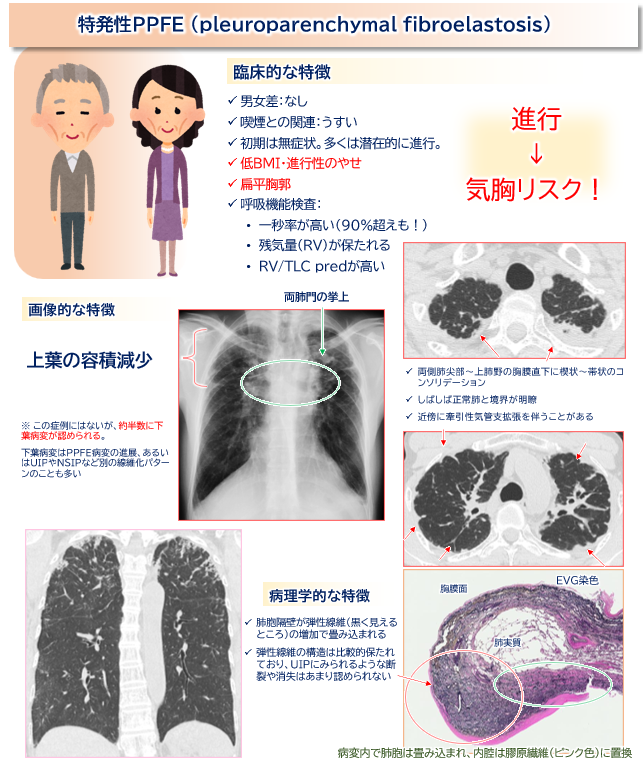 指導医 「Pleuroparenchymal Fibroelastosis（PPFE）は、両側上肺野優位に胸膜直下の線維化や弾性線維の増生を ...
