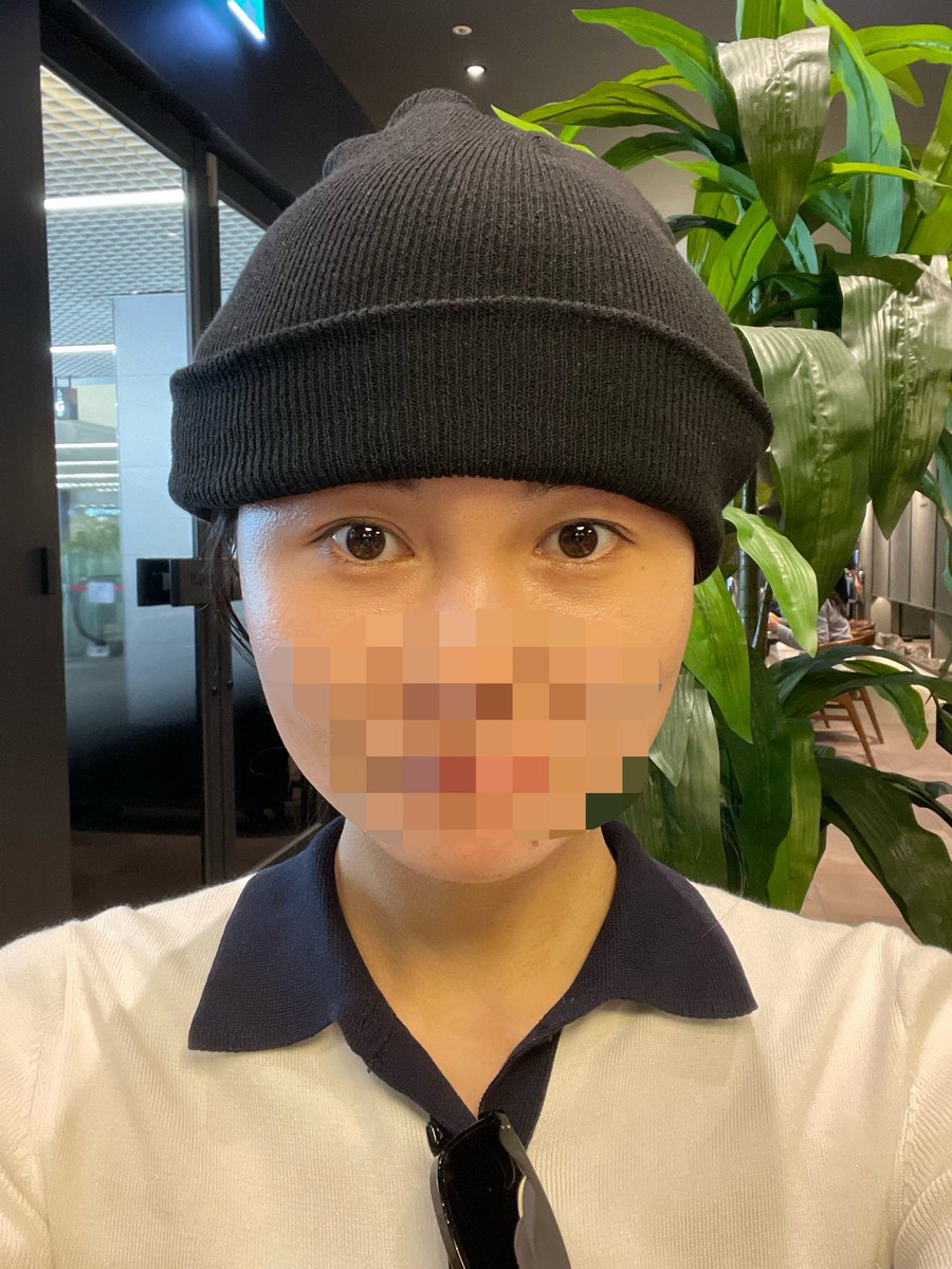 duffy33chan's tweet photo. モモ植毛で植毛してきた🍑
カウセから手術まで日本語話せる方がいて安心だった😌
LINEもすぐ返信くるし、術後の対応も手厚くて、ここにして良かった💭
まだDT中だけど満足度高すぎる
完成楽しみ！ https://t.co/JhLunnr6OT