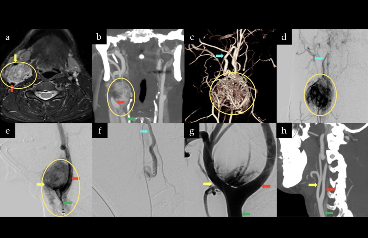 drufukerginoglu's tweet photo. Our new article highlights key lessons in carotid body tumor microsurgery: preoperative embolization, balloon test occlusion, neuromonitoring, and meticulous subadventitial dissection.
https://t.co/3SbM2EMIFu
#Neurosurgery #Microsurgery #Neurovascular https://t.co/wvrw9KXtOa