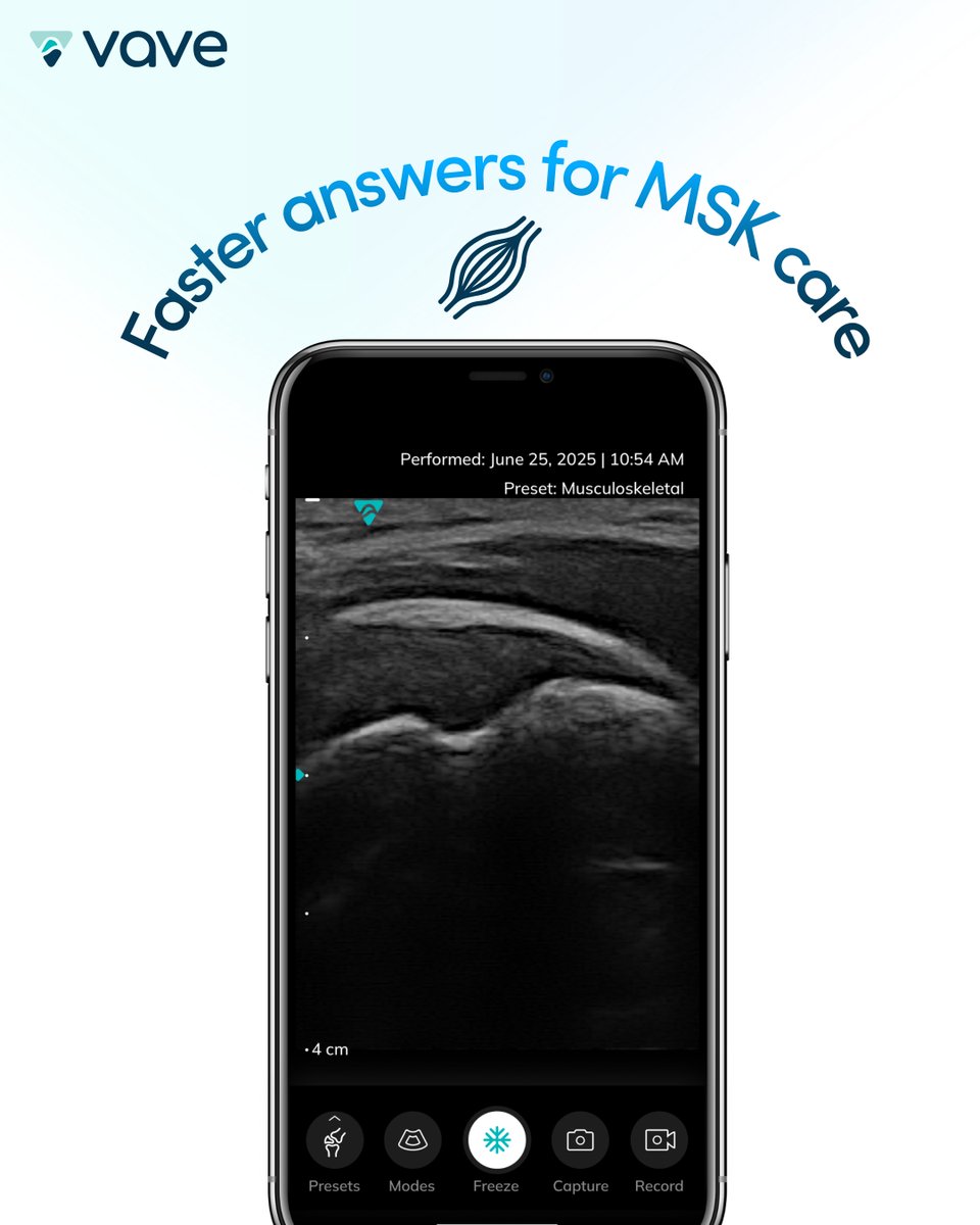 VaveHealth's tweet photo. On-site ultrasound can change the MSK workflow fast:

Fewer referral delays
More real-time decisions
A smoother path to next steps

Full guide here: https://t.co/tHaIB0esJe

#POCUS #Ultrasound #MSK https://t.co/nPY9k3C1BG