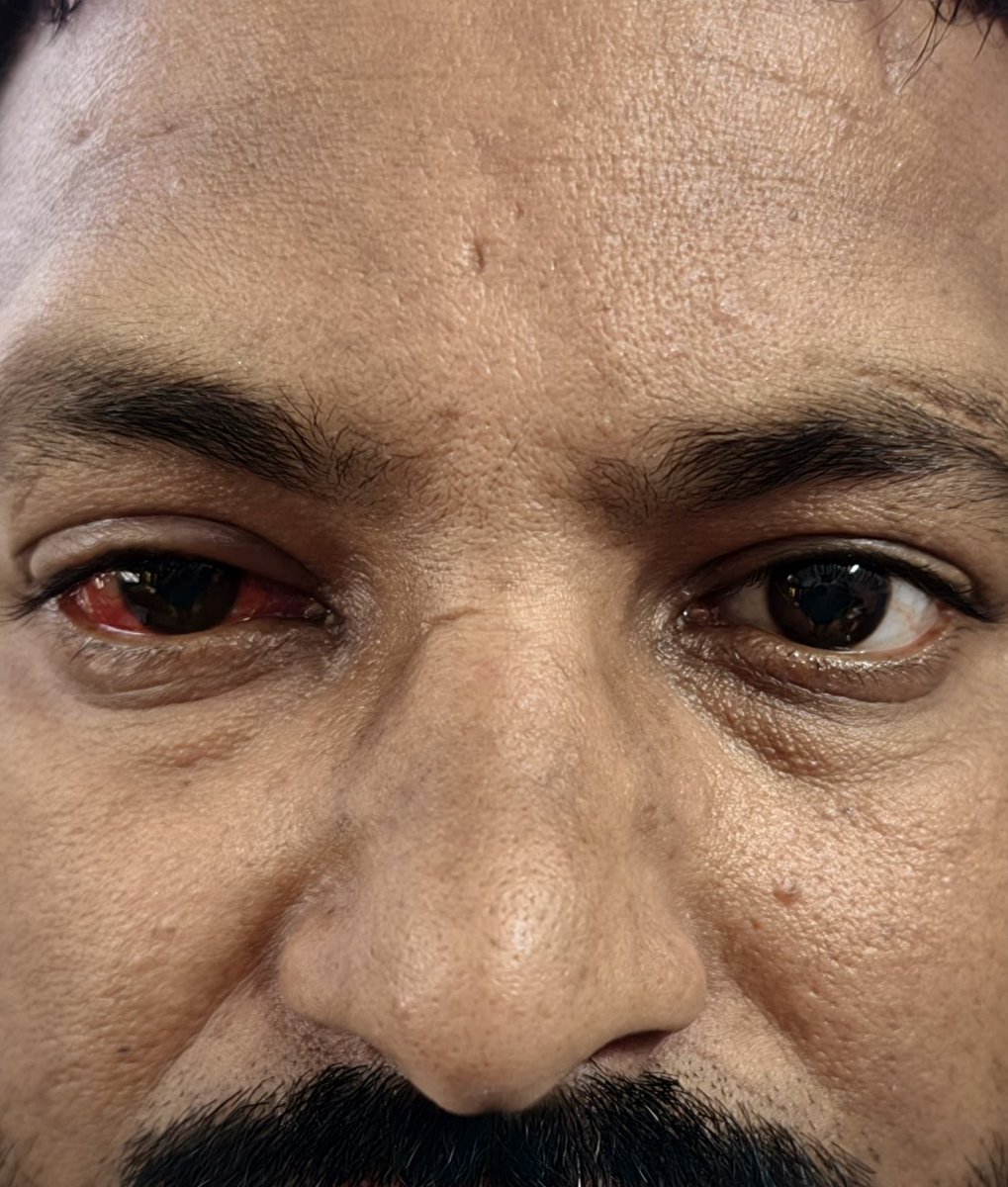 bkneyehosp's tweet photo. The courage to change. 👁️✨
For years, this patient lived with sensory strabismus — his right eye turning outward after losing vision. The self-consciousness was heavy. Surgery felt scary.
Today? He’s standing tall with beautifully aligned eyes.
From this → to just 7 days post-surgery at Bikaner Eye Hospital. (Mild redness is normal & fading fast)
Restoring alignment. Restoring confidence. 💪
Proud to be part of his journey.
If a squint is affecting your life, you don’t have to hide anymore. Reach out — we’re here to help.
#EyeCare #StrabismusSurgery #BikanerEyeHospital