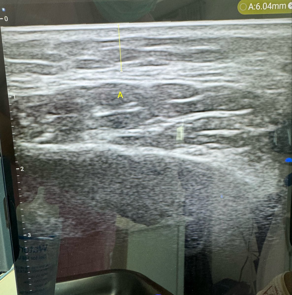 Pop_papp_osk's tweet photo. “ทำไมบางคนยิง Ultraformer แล้วเห็นผลกว่า Ulthera ทั้งที่อีกคนกลับรู้สึกว่า Ulthera ดีกว่า”
(ส่วนตัวอยากมี 2 เครื่องเลย ทำให้หมด ทำครบทุก mode)

จริง ๆ แล้ว เรื่องนี้ไม่ได้มีคำตอบตายตัวว่าเครื่องไหนดีกว่าเสมอไปแต่ละเครื่องมีจุดเด่นต่างกัน และให้ผลได้ต่างกันตามโครงสร้างหน้าของแต่ละคน รวมถึงวิธีการรักษาของแพทย์ด้วย

Ulthera เป็นเครื่องที่มีจุดแข็งเรื่องความแม่นยำ
เพราะมีระบบ ultrasound imaging ที่ช่วยให้มองเห็นชั้น SMAS (แนวนอนที่หนาที่สุดที่ultrasoundมองเห็น)จริงของคนไข้ในขณะทำแพทย์จึงสามารถประเมินได้ว่า SMAS ของแต่ละคนอยู่ลึกแค่ไหน และเลือกยิงในตำแหน่งที่เหมาะสมได้มากขึ้น

เมื่อใช้ร่วมกับการยิงแบบ dot mode พลังงานจะลงเป็นจุดที่ค่อนข้างแม่นยำในแนวระนาบของชั้น SMAS จึงเหมาะกับคนที่ต้องการการ targeting ที่ละเอียดและเฉพาะเจาะจงแต่ถ้าลึกเกิน4.5mm ก็ไม่มีหัวยิงนะ สำหรับ Ulthera

ในขณะที่ Ultraformer MPT มีจุดเด่นอีกแบบหนึ่ง โดยเฉพาะ continuous mode หรือ MP modeที่สามารถสร้าง thermal zone ต่อเนื่องในชั้นไขมั���ได้กว้างกว่า  พลังงานที่กระจายต่อเนื่องนี้อาจครอบคลุม fibrous septa (บางคนก็นับเป็นSMAS complex ที่แทรกอยู่ ultrasound มองไม่เห็น) ซึ่งเป็นพังผืดแนวตั้งที่คอยพยุงชั้นไขมันไว้ได้มากขึ้นในบางคนจึงรู้สึกว่ากรอบหน้าถูกดึงกระชับ หรือชั้นแก้มดูแน่นขึ้นชัดเจน

อีกปัจจัยหนึ่งคือจำนวนชอตและพลังงานรวมที่ใช้จริง���นการรักษาในหลายเคส Ultraformer สามารถยิงได้จำนวนชอตค่อนข้างมากในงบประมาณใกล้เคียงกันทำให้ total energy ที่ลงสู่ผิวสูงขึ้นได้และถ้าตำแหน่ง focal point ลงโดนชั้น SMAS ได้เหมาะสมด้วยผลลัพธ์ที่ได้ก็อาจไม่ได้ต่างจาก Ulthera มากอย่างที่หลายคนคิด (ก็อาศัยประสบการณ์เทคนิค)

สิ่งที่ทำให้แต่ละคนรู้สึกกับเครื่องไม่เหมือนกัน
จึงมักเกี่ยวกับโครงสร้างของใบหน้าเดิมมากกว่า
คนที่มี fat layer หนา หรือมี��ขมันสะสมบริเวณแก้มและกรอบหน้าอาจตอบสนองกับ continuous mode ได้ดีเป็นพิเศษเพราะพลังงานครอบคลุมชั้นไขมันและ fibrous septa ได้มากกว่า

ส่วนคนที่ต้องการการยกในระดับ SMAS แบบเฉพาะจุดUlthera จะมีข้อได้เปรียบ หากมีการใช้ imaging อย่างละเอียดจริง  แต่ในทางกลับกัน
ถ้าใช้ Ulthera โดยไม่ได้อาศัย imaging อย่างจริงจังข้อได้เปรียบสำคัญของเครื่องก็อาจลดลงไปมาก

อีกประเด็นหนึ่งที่เจอคนที่ไม่ทำอะไรเลยมาเจอเ���รื่องไหนเป็นเครื่องแรกแล้วกู้หนัาได้เยอะกว่าจะประ��ับใจ เพราะไปทำเครื่องถัดไปเหมือนฟิล maintain ละจะไม่ค่อยต่างมาก

มีงานวิจัยของ Ultraformer MPT ในปี 2024
ที่ใช้การวัดผลด้วย 3D scanner 50 คน พบว่า posterior cheek และ neck ยกได้ 3.38–3.55mm และระบุชัดว่า HIFU เพิ่ม elasticity ของ fibrous septae ได้จริง
https://t.co/d4dZJTH1iI