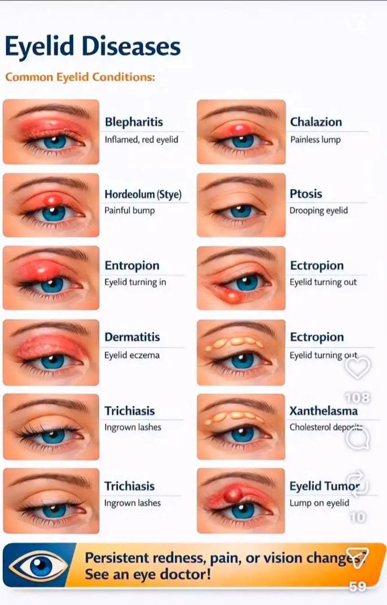 smahup1's tweet photo. Eyelid diseases ( common eyelid conditions ) https://t.co/nl56JRPhfZ